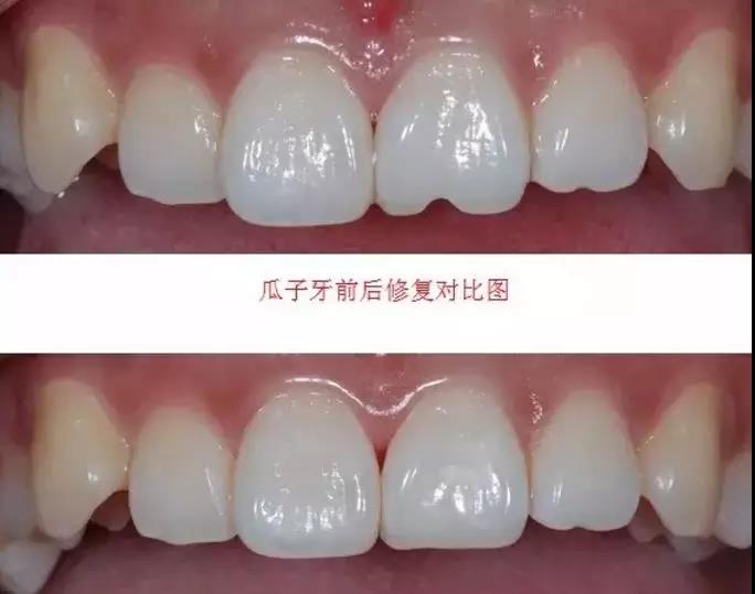 瓜子虽然好吃,但是小心"瓜子牙"